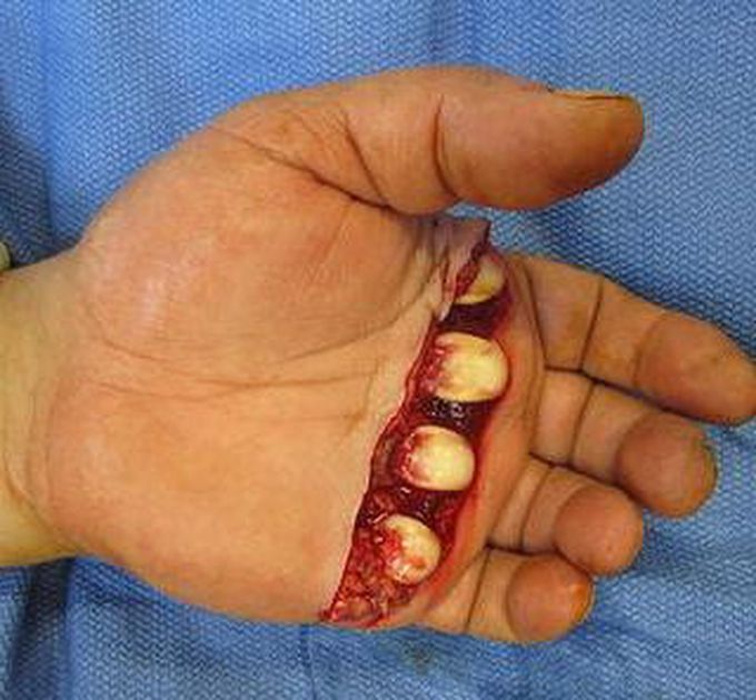 Open dorsal metacarpophalangeal joint dislocations