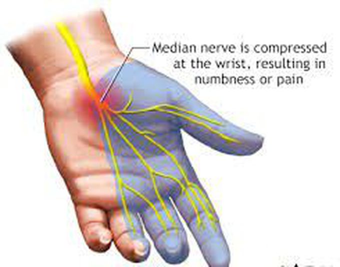 Causes of carpel tunnel syndrome