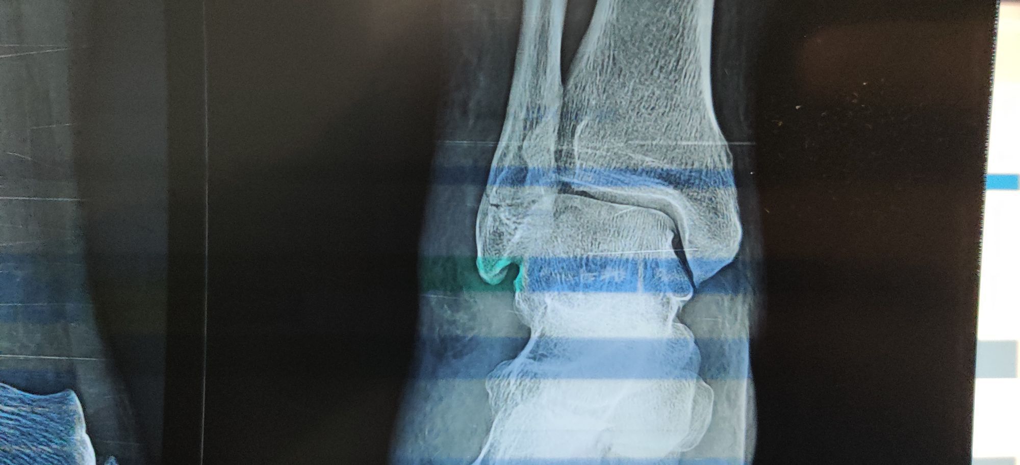 fracture-lateral-malleolus-medizzy