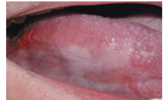 Homogenous leukoplakia