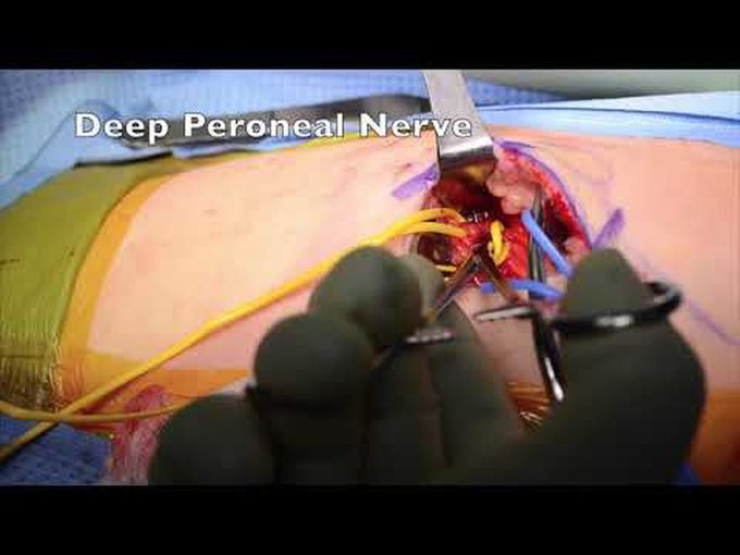 Peroneal nerve decompression