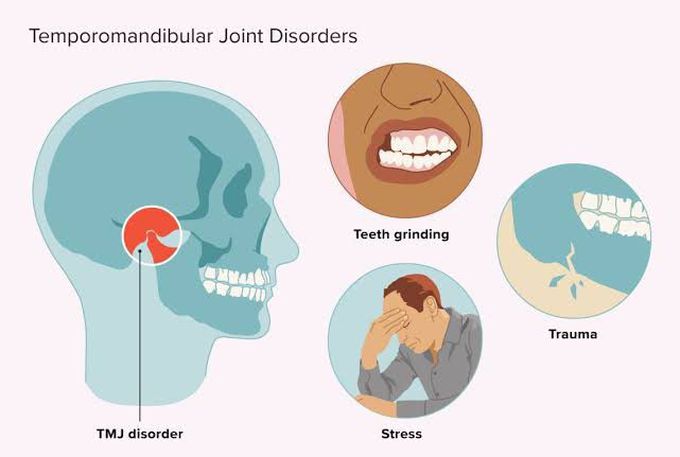 Causes of TMJ disorders