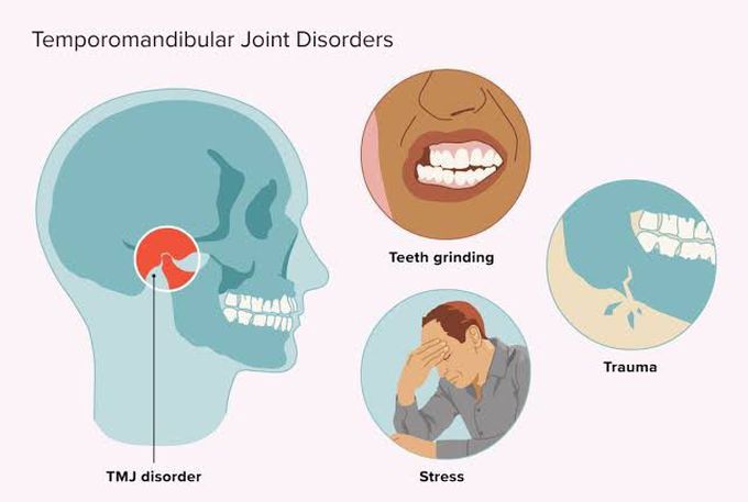 Causes Of TMJ Disorders MEDizzy