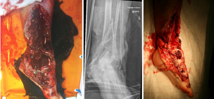 Multi-disciplinary Approach for Managing Paediatric Lower Limb Trauma
