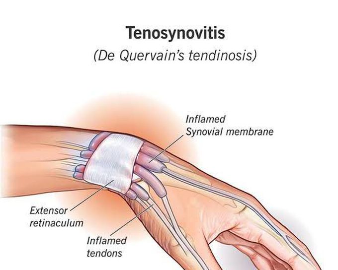 These are the symptoms of De Quervain's syndrome