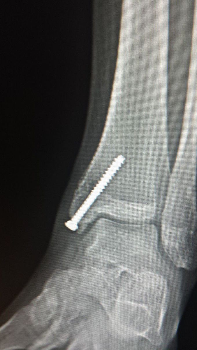 My ankle