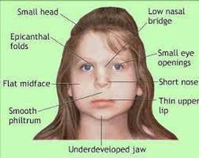 velocardiofacial syndrome facial features