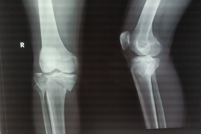 tibial  fracture
