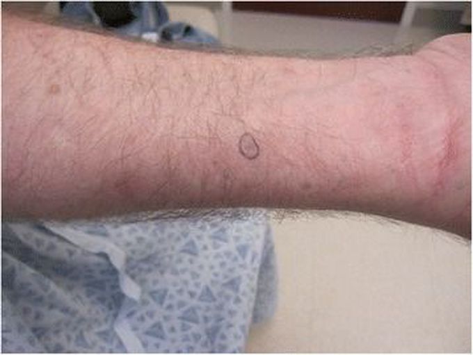 Dermally Implanted Rubber