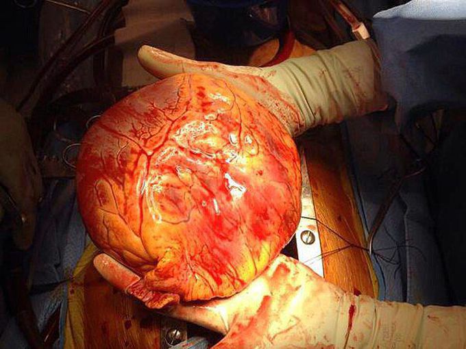 Mega-size heart