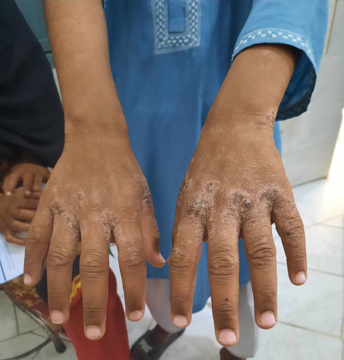 Scabies