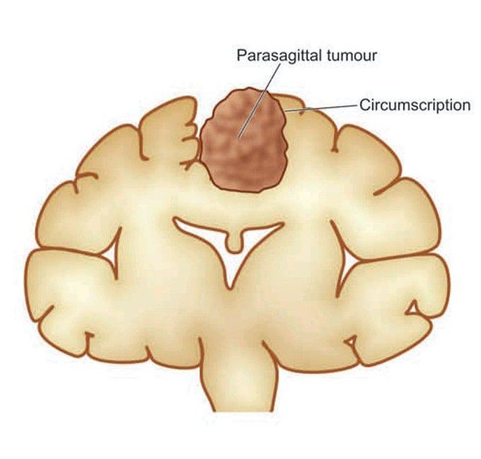 Meningioma