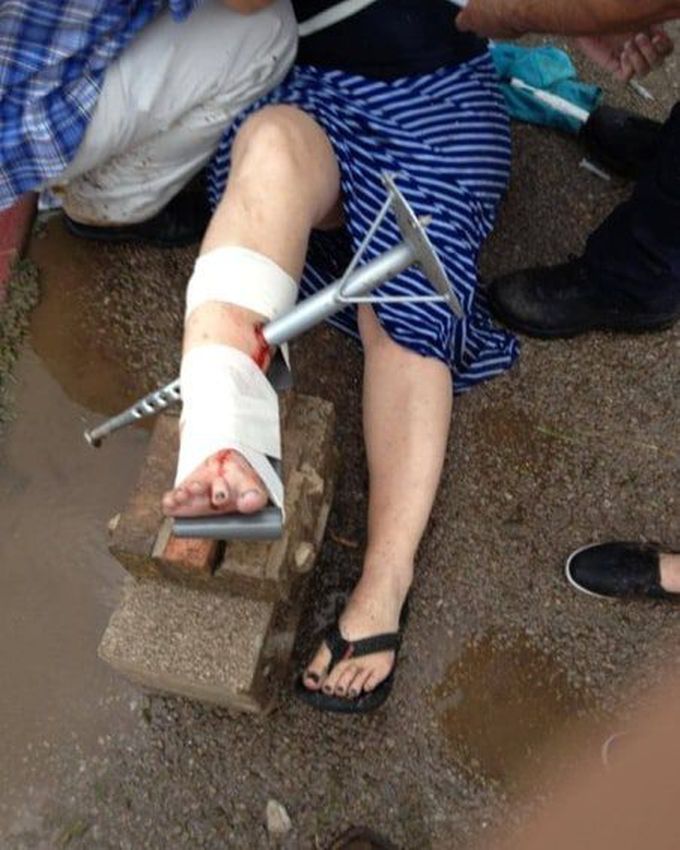 Teacher impaled in leg protecting students during a tornado. 