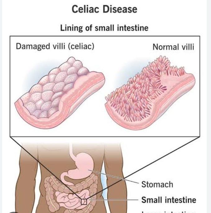 Celiac disease