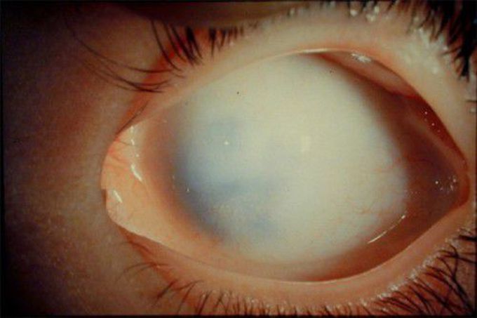 Sclerocornea