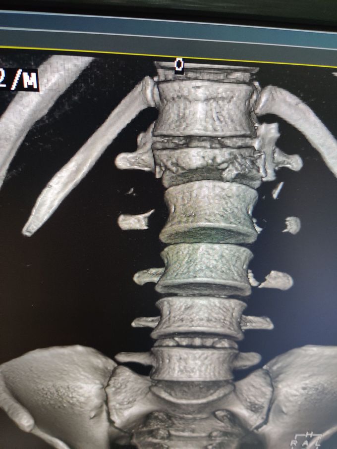 L1 compressed fracture with fractured pedicles of L2 and L3