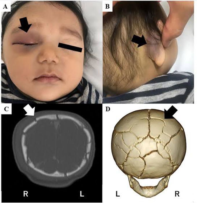 causes of basillar skull fracture