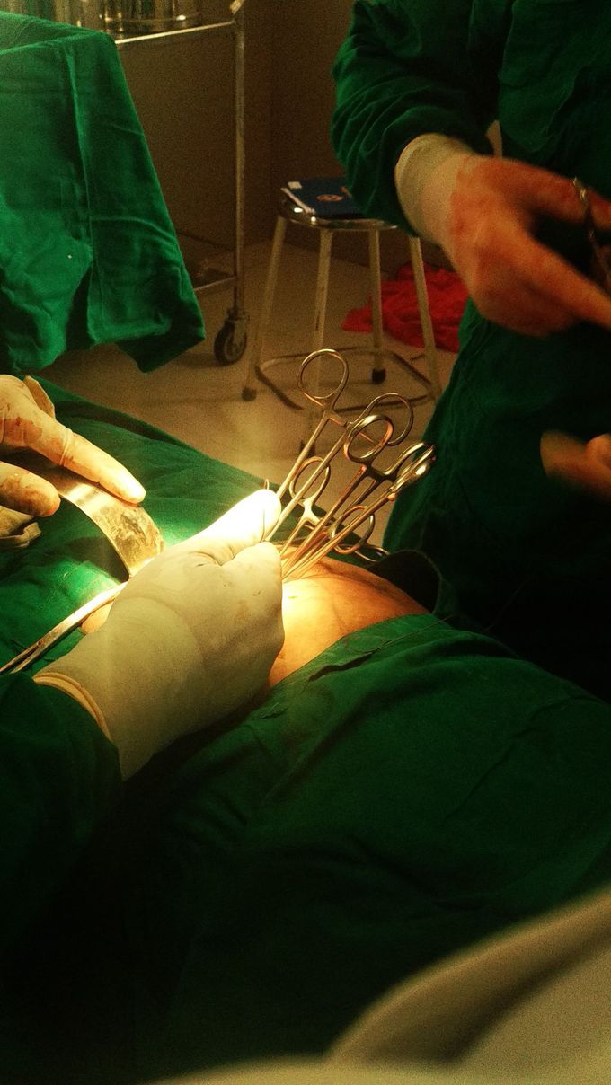 During Hysterectomy surgery.