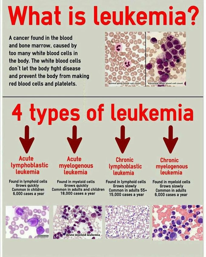 Leukaemia