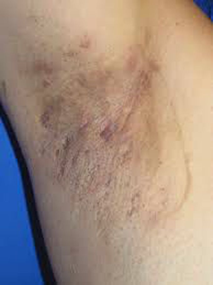 Hidradenitis suppurativa on the thighs: Pictures and more