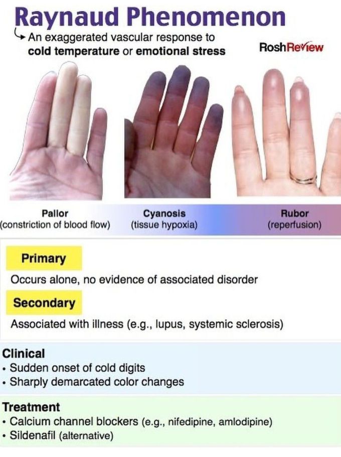 Raynaud's Phenomenon