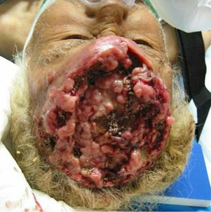 Now let's go for differential challenge, say what u think can cause this? It doesn't mean that u should be correct ,just say something close to its manifestation.. For example squamous cell carcinoma can cause that