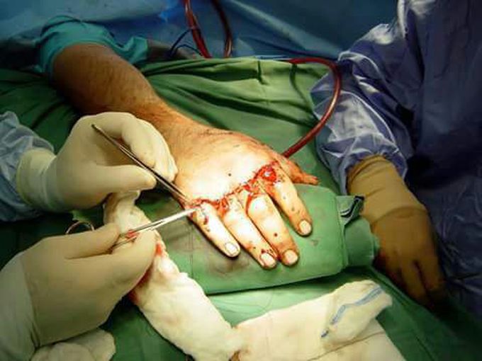 Sthich of cutting hand