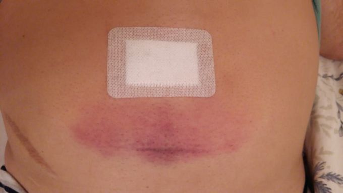 Red spot appeared after operation