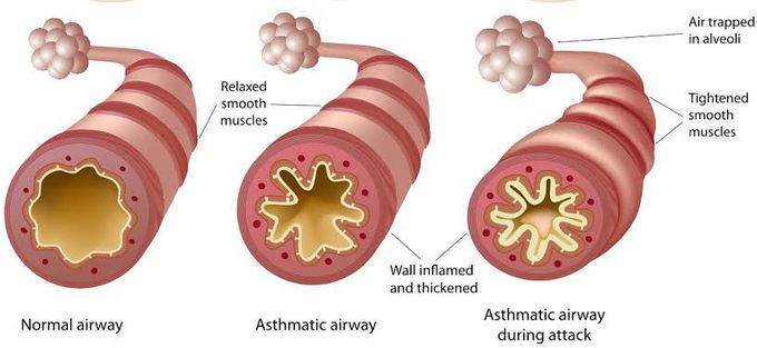 Common triggers of asthma?