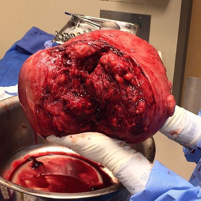 Holding this 9lb 10oz (4.5kg) mega sized uterus with multiple gigantic fibroids is just too satisfying!  
