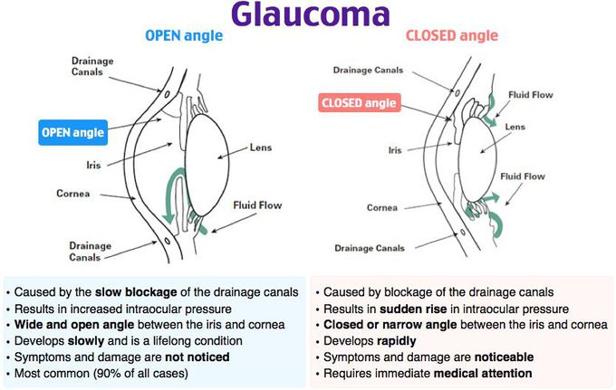 Difference between open angle and closed angle glaucoma