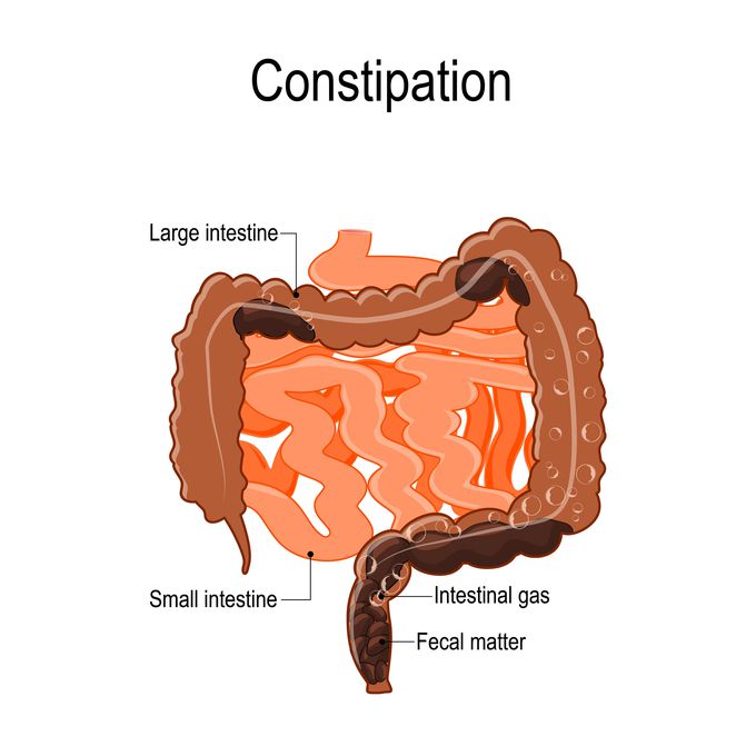 What is constipation?