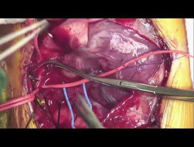 Right MBT Shunt With Cryopreserved Saphenous Vein in DORV With Criss-Cross Heart and Severe RVOT