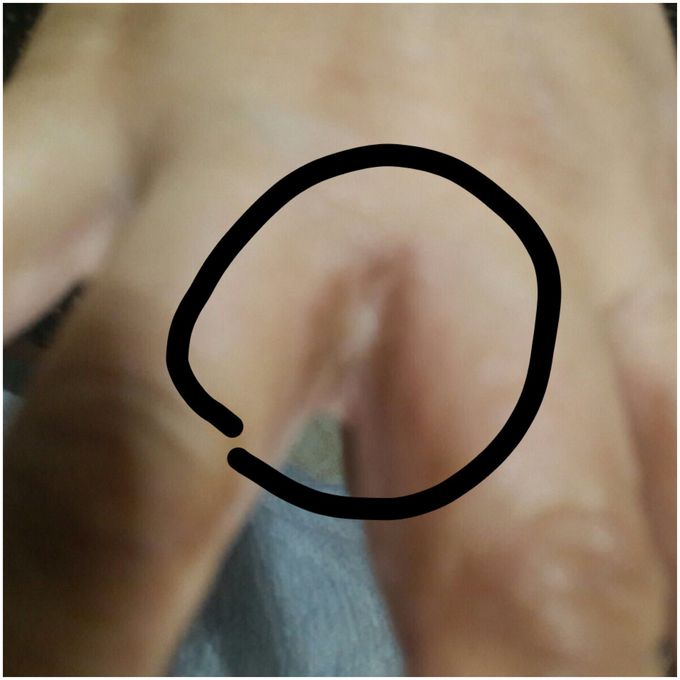 erythema itching