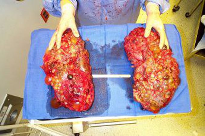 Polycyst kidney