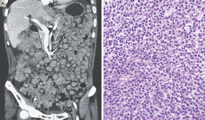 Metastatic Clear-Cell Sarcoma