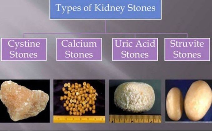 Types of Kidney Stones