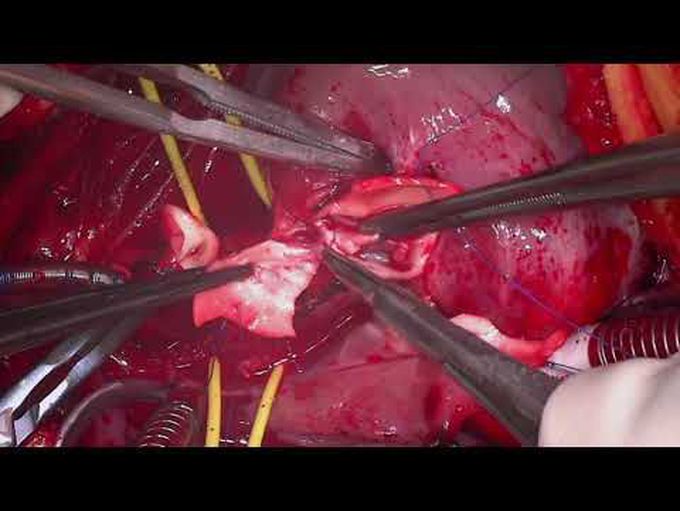 Arterial Switch Operation and Mee Procedure