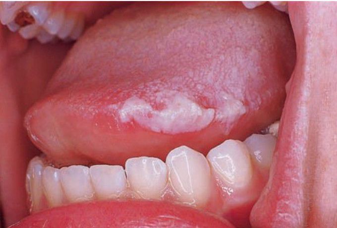 Anesthesia-associated acute tongue ulcer