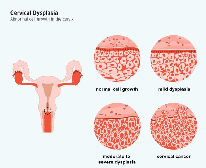 Cervical dysplasia