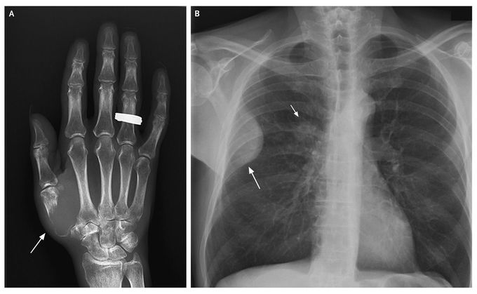Pain in the Thumb Related to Disease in the Lung