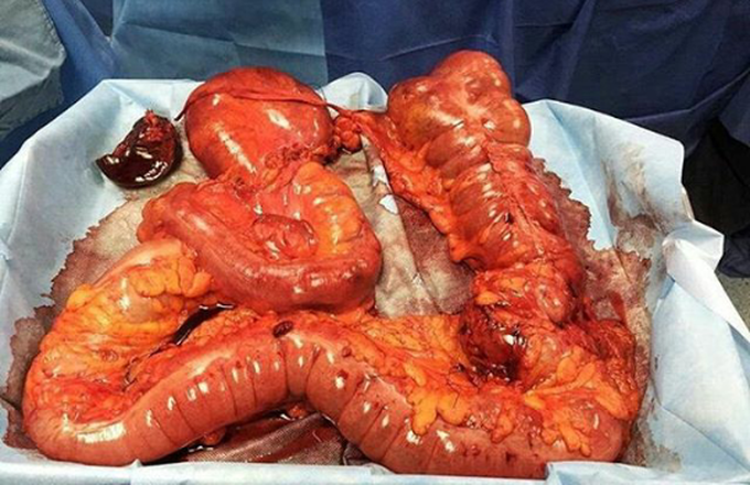Megacolon