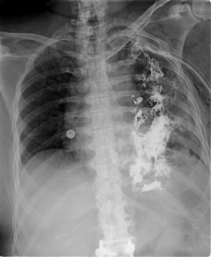 Mackler’s Triad in Boerhaave Syndrome