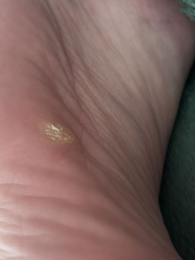 i-have-had-this-lump-of-hard-skin-on-my-foot-since-i-was-a-medizzy