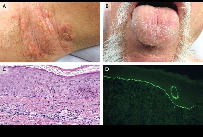Vancomycin-Induced Linear IgA Bullous Dermatosis