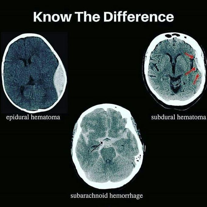 Epidural Hematoma Vs. Subdural Hematoma Vs. Subarachnoid hemorrhage