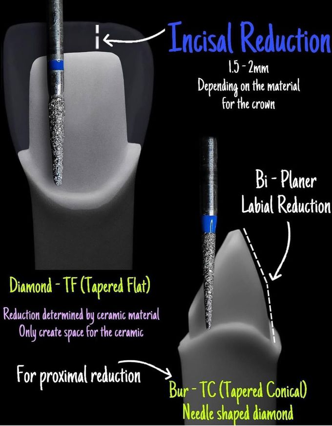 All-Ceramic Crown Tooth Preparation I