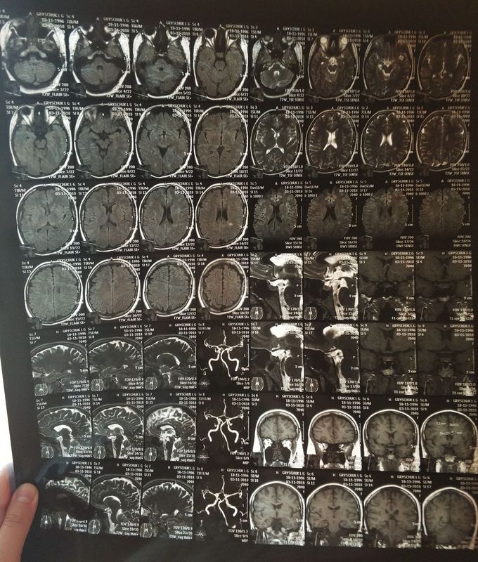 Brain mri