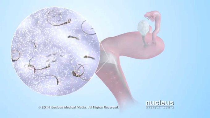 Cervical Cap