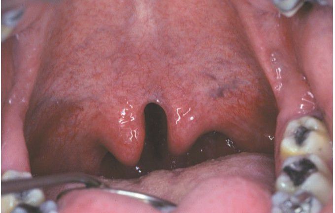 Bifid uvula